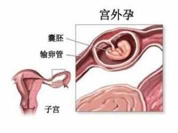 宫外孕五个月后的我